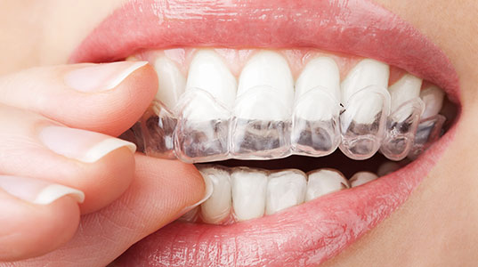 Invisalign