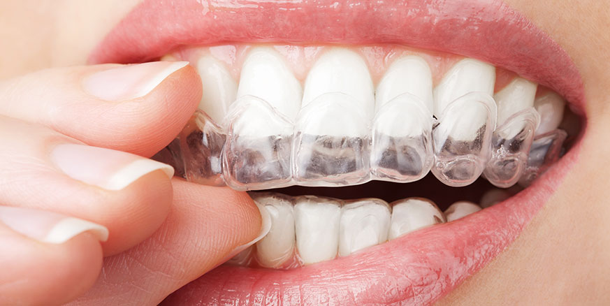 Invisalign